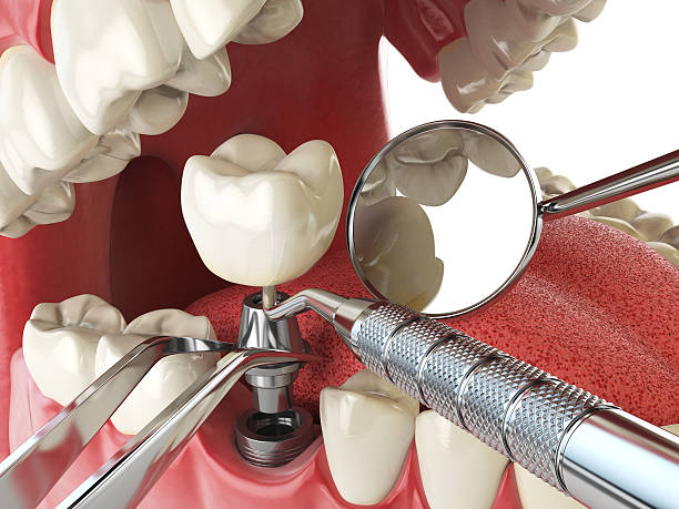 Best Emergency Root Canal Treatment in Luverne, MN